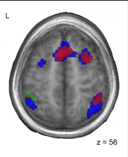 Bilingualism is never lost at brain level, although one of the languages is no longer used